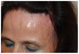 frontal fibrosing alopecia