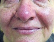 acne rosacea