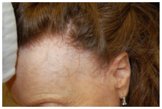 alopecia fibrosante frontale