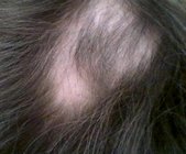 alopecia