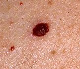 angioma