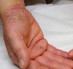 eczema