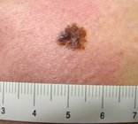 melanoma