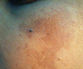 melasma