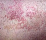 orticaria